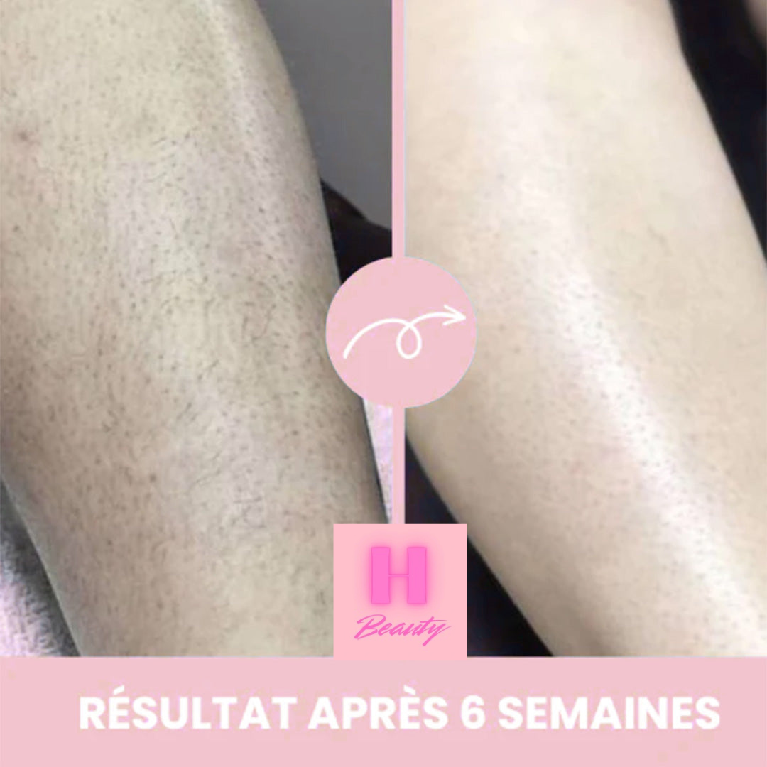 H Beauty | Épilateur à Lumière Pulsée IPL