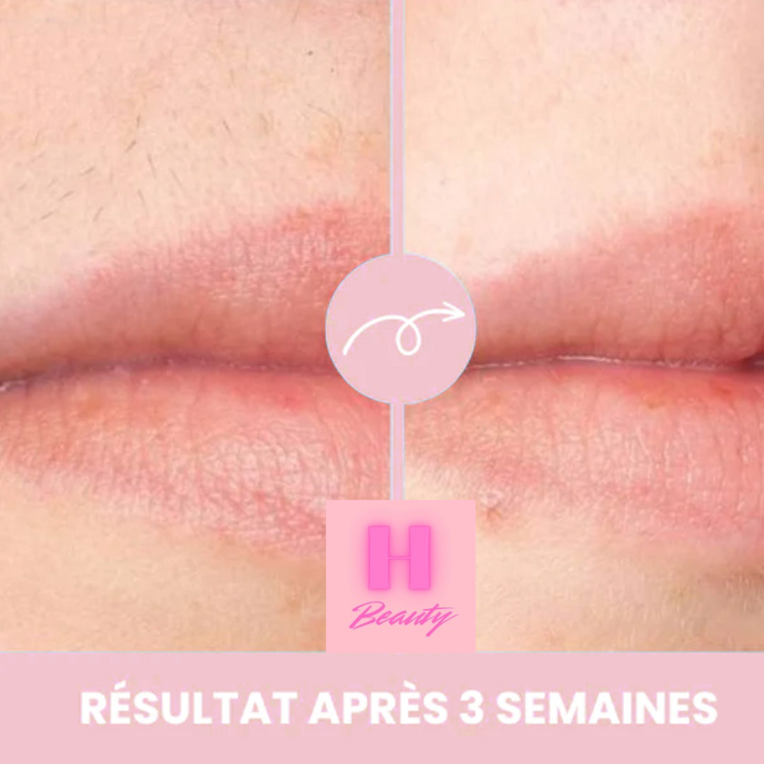 H Beauty | Épilateur à Lumière Pulsée IPL